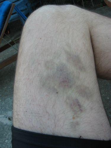 2005-10-16p Bruises.jpg
